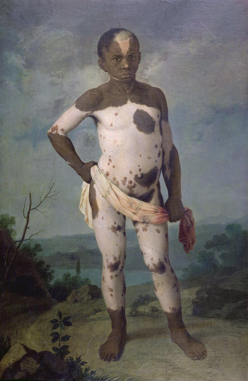 Kind met vitiligo, 1786 door Brazilian School