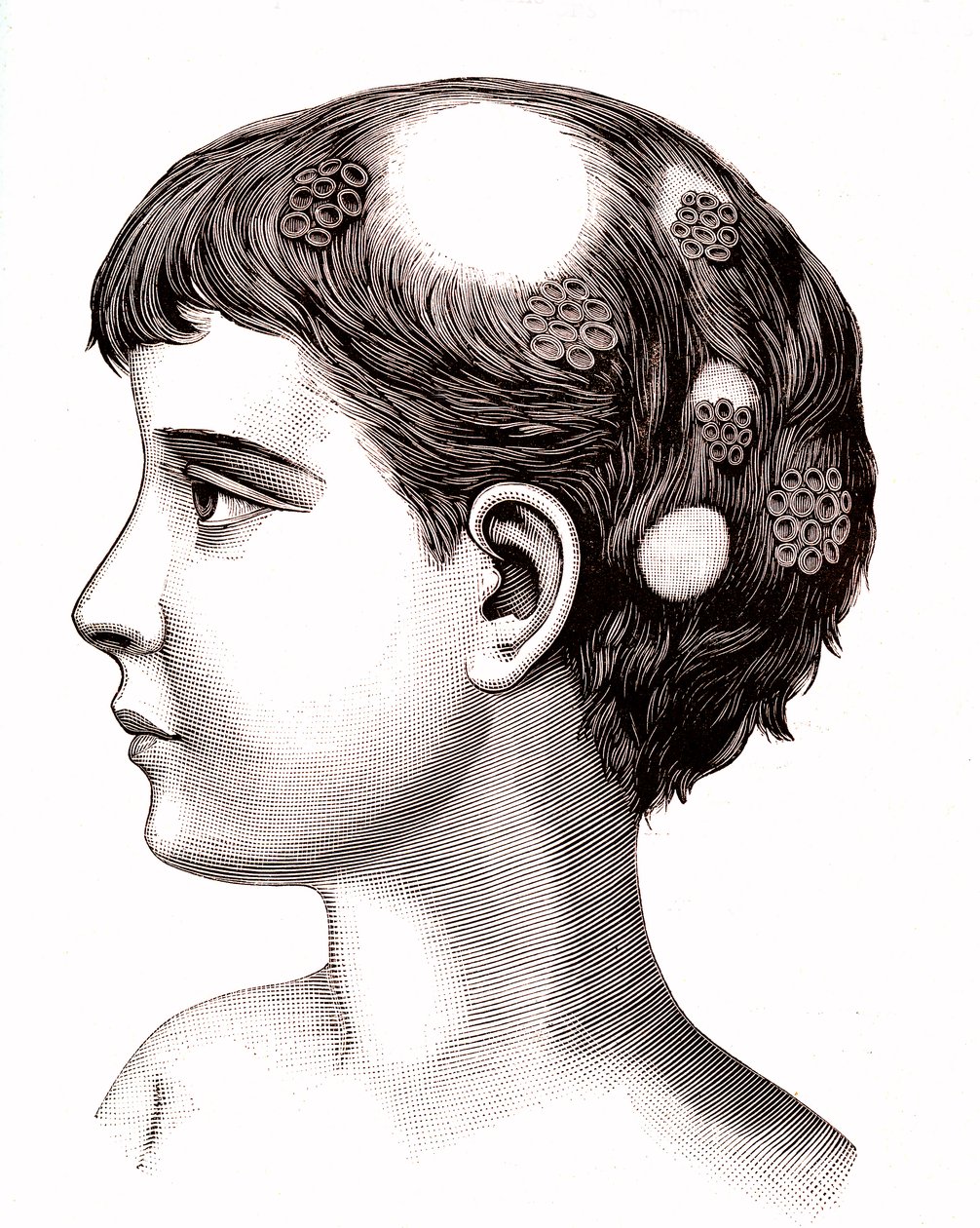 Ringworm bij kind. 1887 (gravure) door French School
