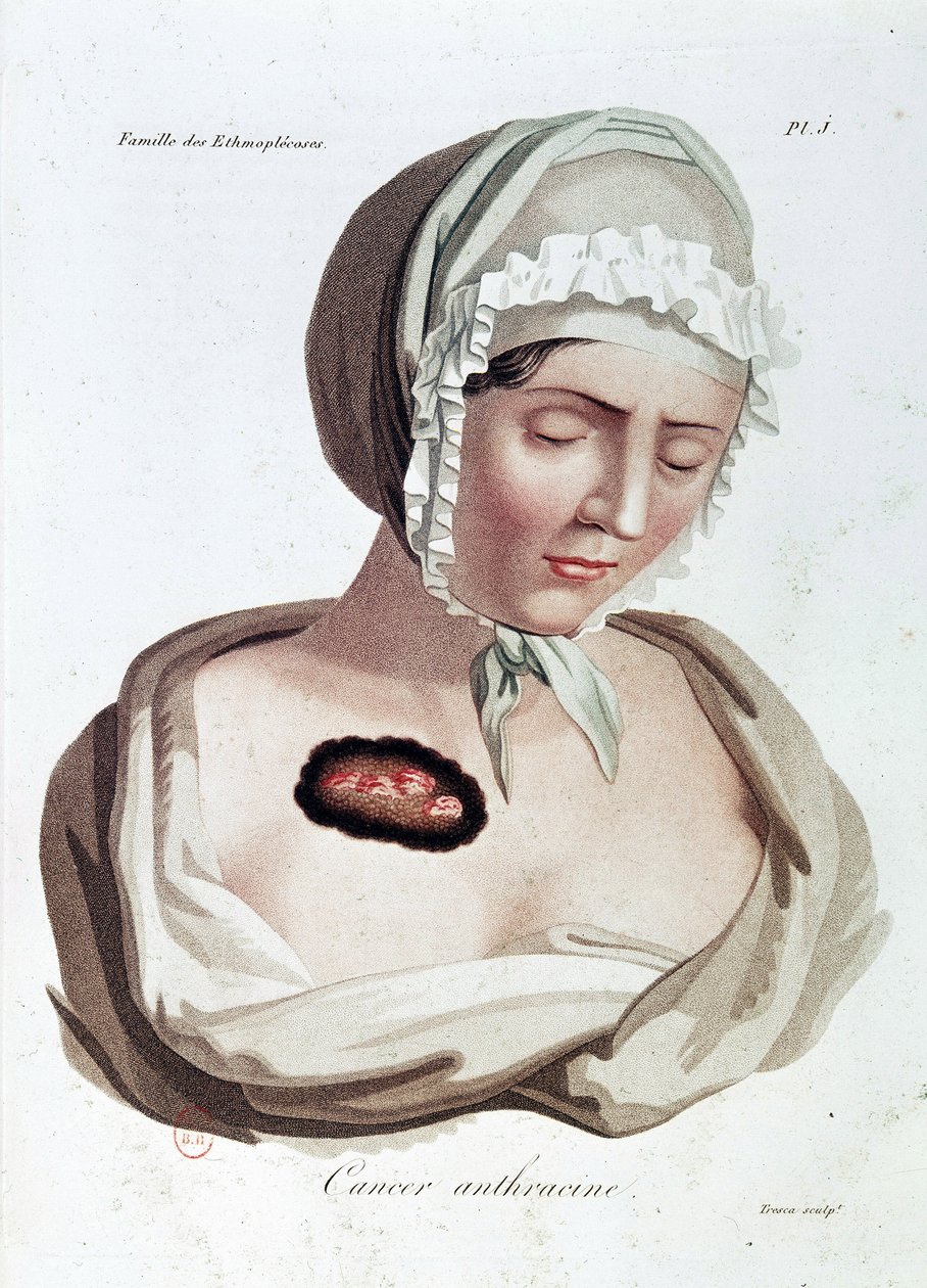 Anthracine kanker - Alibert, B.N. door Jean Louis Alibert