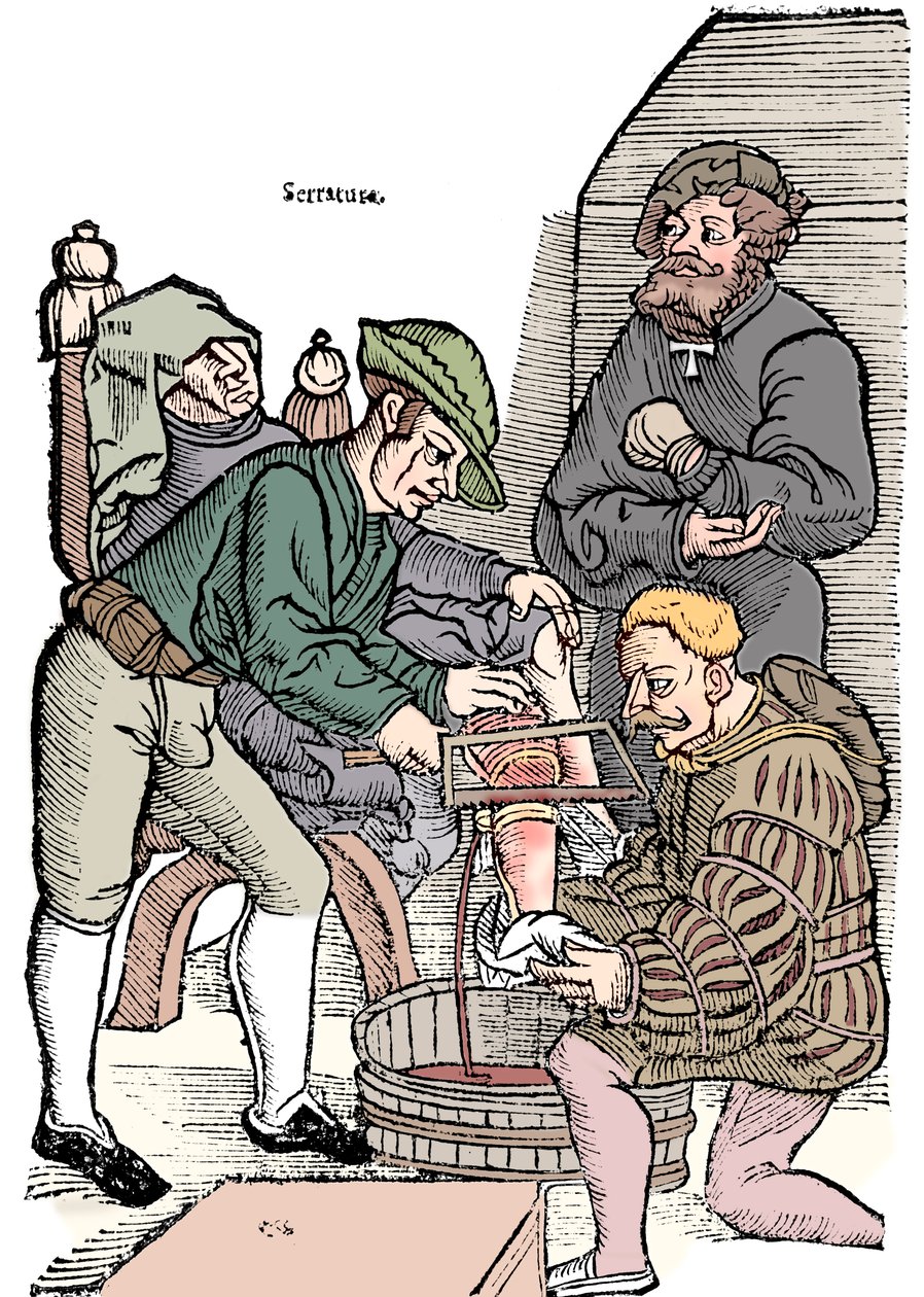Amputatie van een been zonder verdoving, 1593 door Unbekannt