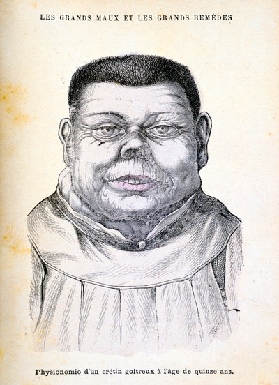 Cretin 15 jaar oud, ca. 1890 door Unbekannt